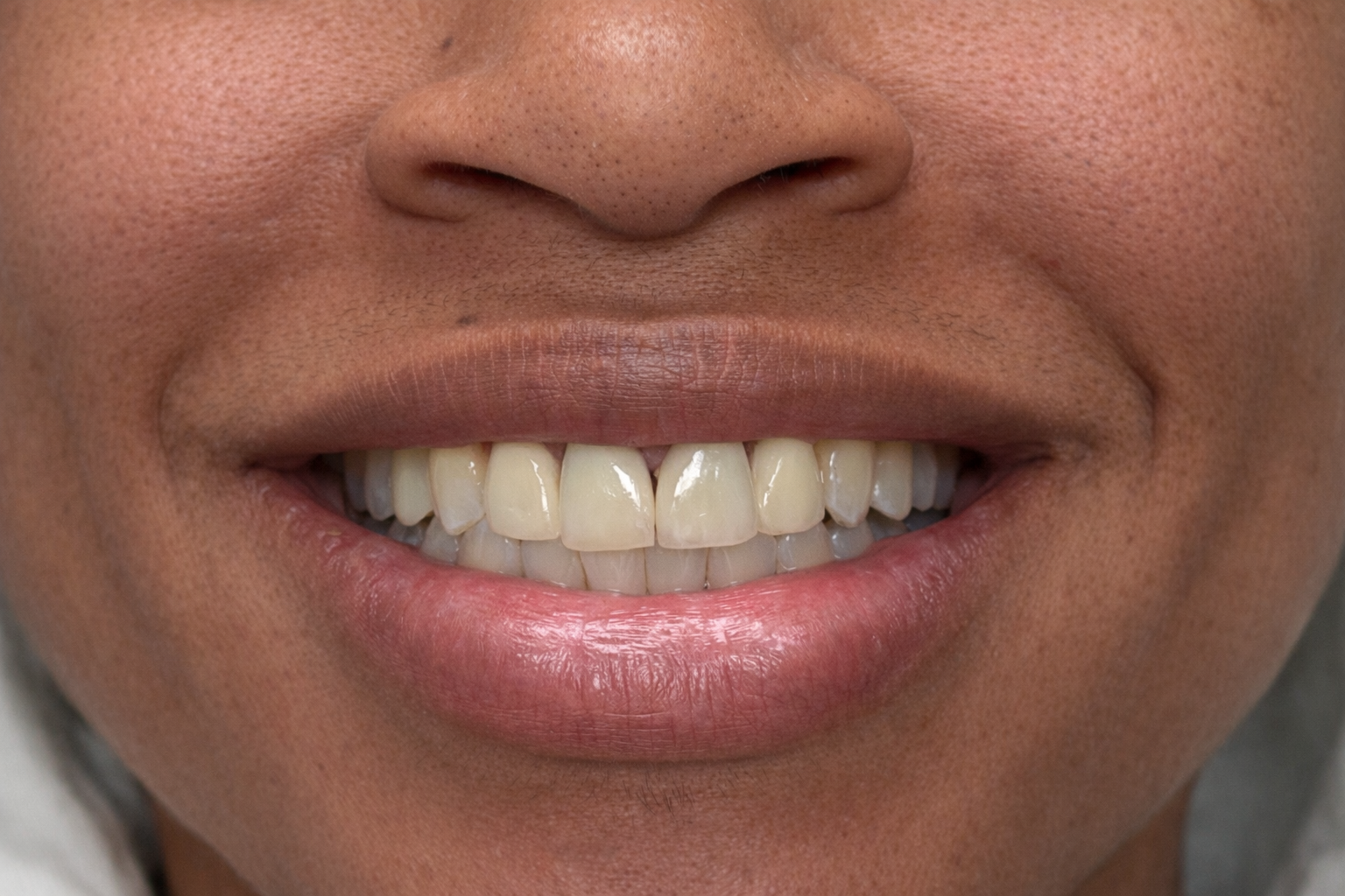 After veneers treatment